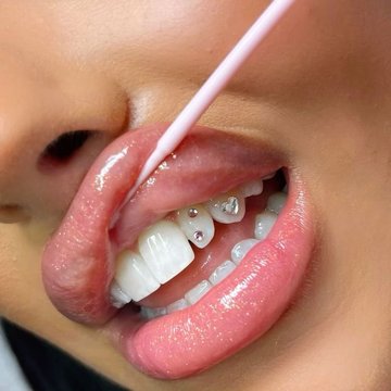profesjonalne tooth gems
