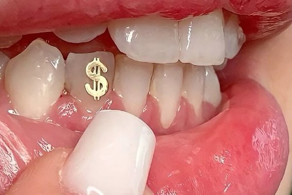 Tooth gems