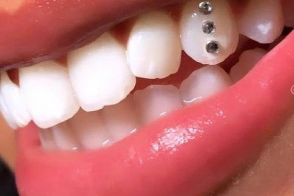 profesjonalne tooth gems